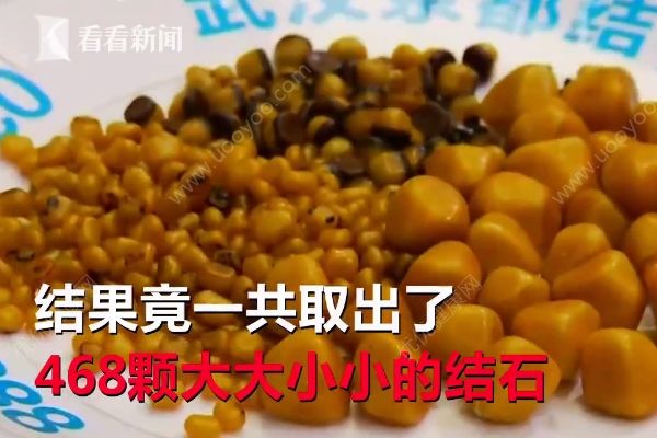 愛吃油炸長468顆結(jié)石，油炸食品的危害有哪些？(1)