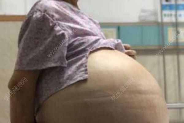 69歲大媽患婦科腫瘤肚鼓如球，醫(yī)生抽出30多升囊液(1)