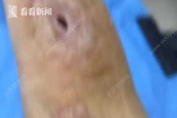 男子殺魚時(shí)不小心劃傷手指，幾個(gè)月后右手手臂被