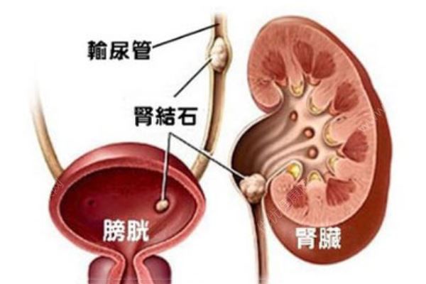 常州一大媽右腎里取出一盆結(jié)石，醫(yī)生一數(shù)，竟有2980顆(2)