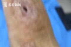 男子殺魚時(shí)不小心劃傷手指，幾個(gè)月后右手手臂被"蛀空"[多圖]