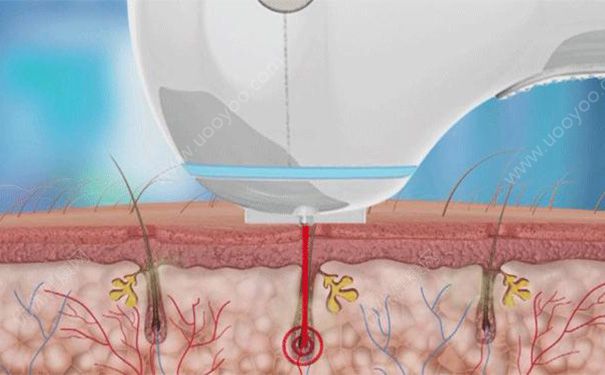 激光脫毛有副作用么？激光脫毛有什么副作用？(2)