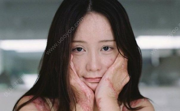 毀容少女曬寫真 毀容后如何樂觀生活？(2)