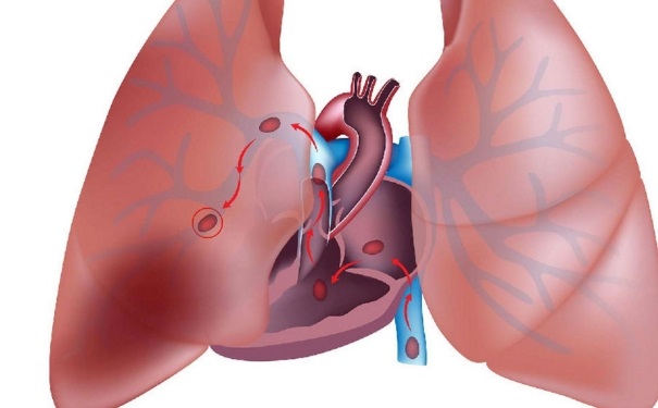 肺栓塞的癥狀有哪些？肺栓塞的臨床表現(xiàn)是什么？(1)