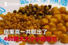 愛吃油炸長468顆結(jié)石，油炸食品的危害有哪些？[多圖]