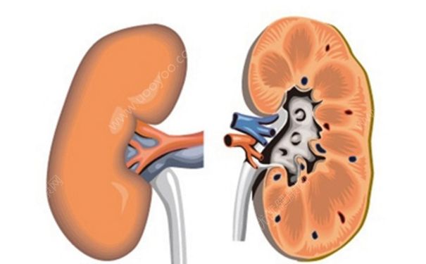 腎囊腫是怎么回事？腎囊腫治療方法(1)