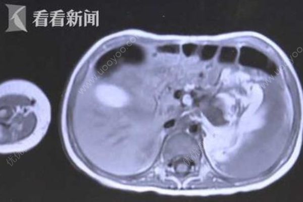 3歲女童腹腔長直徑約15厘米腫瘤，嬰幼兒腫瘤如何早發(fā)現(xiàn)？(2)