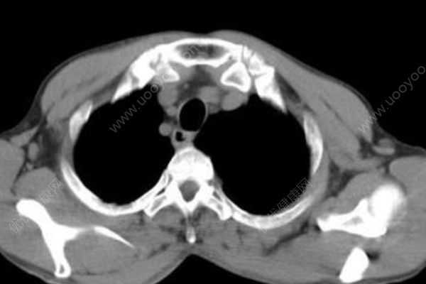 30歲小伙沒力氣上二樓，塵肺病肺已經(jīng)千瘡百孔(4)