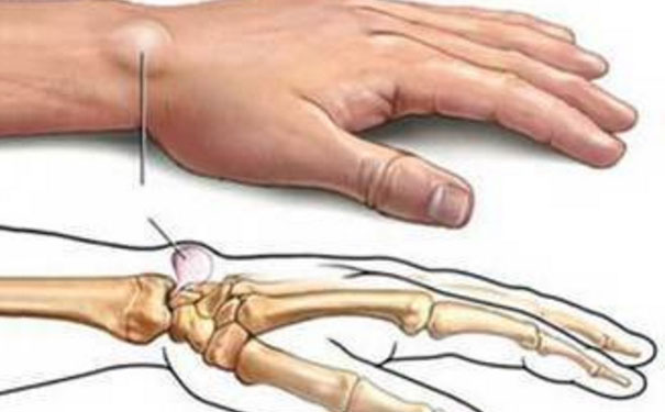 手腕起了一個(gè)鼓包怎么回事？手腕鼓包是什么原因？(1)