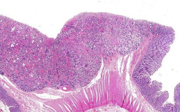 直腸癌有哪些病因？直腸癌有何治療方法？(3)