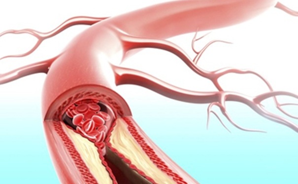 動脈硬化和動脈粥樣硬化 動脈硬化和動脈粥樣硬化有什么區(qū)別？(1)