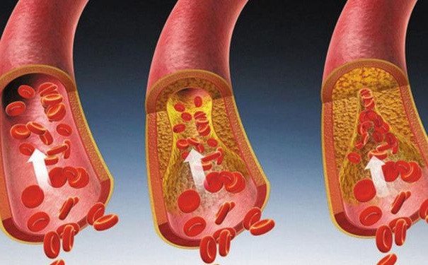 如何清除血管內(nèi)垃圾？血管有垃圾有何危害？(1)