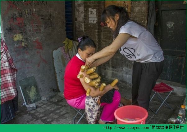 拔火罐有什么作用？拔罐的好處有哪些？(3)