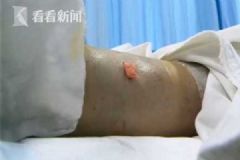 女子清晨上廁所踩到毒蛇被咬，整條腿變"大象腿"[多圖]