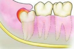 智齒發(fā)炎應(yīng)該怎么辦？智齒很疼該不該拔掉？[多圖]