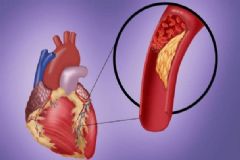 動脈硬化有何癥狀？動脈硬化如何診斷？[圖]