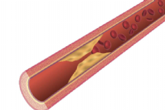 吃哪些食物預(yù)防動(dòng)脈硬化？預(yù)防動(dòng)脈硬化有哪些有效方法？[圖]