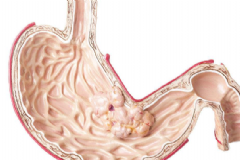 胃癌早期的癥狀有哪些？如何及時(shí)發(fā)現(xiàn)胃癌征兆？[圖]