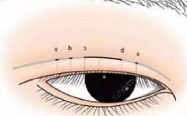 雙眼皮修復多少錢？雙眼皮修復成單眼皮可以嗎？(1)