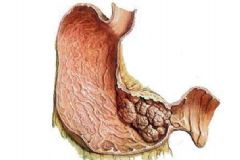 胃癌早期能治好嗎？胃癌早期有那些癥狀？[圖]