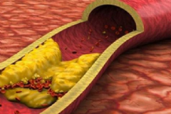高血脂有哪些危害？怎樣降低血脂？[圖]