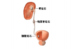 膀胱結(jié)石手術(shù)治療會有效嗎？膀胱結(jié)石手術(shù)治療的效果[圖]