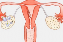 卵巢切除后怎么保養(yǎng)好？卵巢切除后怎么保養(yǎng)？[圖]