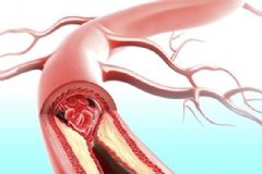 動脈硬化和動脈粥樣硬化 動脈硬化和動脈粥樣硬化有什么區(qū)別？[圖]