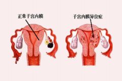 子宮內(nèi)膜異位癥能自然懷孕嗎？子宮內(nèi)膜異位癥為什么影響懷孕？[圖]