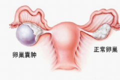 卵巢腫瘤嚴(yán)重嗎？卵巢腫瘤手術(shù)[圖]