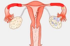 輸卵管堵塞還能排卵嗎？輸卵管堵塞怎么辦？[多圖]