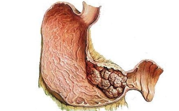 胃癌早期能治好嗎？胃癌早期有那些癥狀？(1)