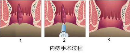 武漢江漢博仕醫(yī)院：肛瘺手術(shù)多久能恢復(fù)