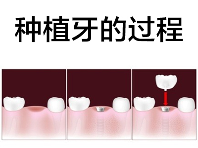 天津皓圣4顆半口種植牙圖片