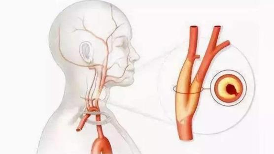 血管狹窄是什么意思？血管狹窄可以恢復(fù)嗎？
