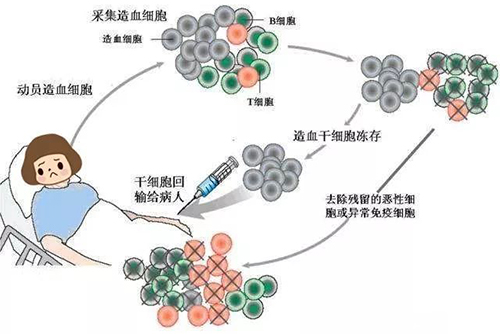 濟(jì)南血液病醫(yī)院：治療淋巴瘤自體造血干細(xì)胞移植效果咋樣？