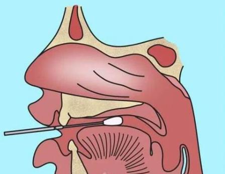 核酸檢測新冠病毒的常用手段：口腔拭子、鼻腔拭子檢測圖示