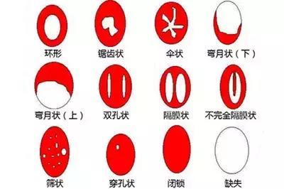 14歲女孩處女膜長(zhǎng)什么樣？14歲女孩有處女膜嗎？[圖]