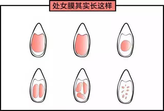 14歲女孩處女膜長什么樣？14歲女孩有處女膜嗎？[圖]