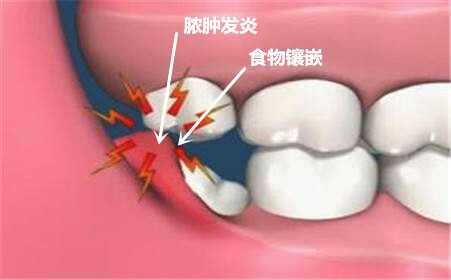 牙菌斑以及食物殘?jiān)热菀讓?duì)拔智齒的創(chuàng)口造成感染。