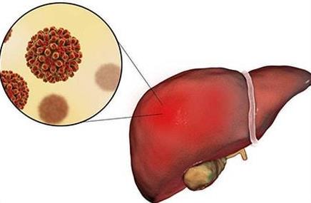肝病怎么徹底治好？如何預(yù)防肝病
