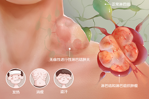 濟(jì)南血液病醫(yī)院科普：確診淋巴瘤該如何治療？自體移植效果好嗎？