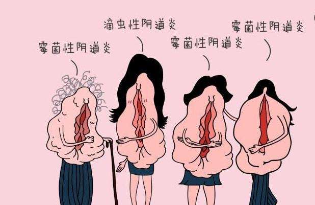 女性在生活中怎樣預(yù)防女性私處炎癥？女性私處炎反復(fù)發(fā)作原因[圖]