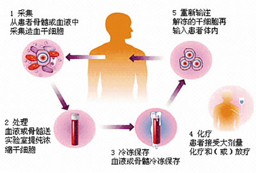 濟南血液病醫(yī)院科普：骨髓瘤是咋引起的？患者自體移植有風險嗎？