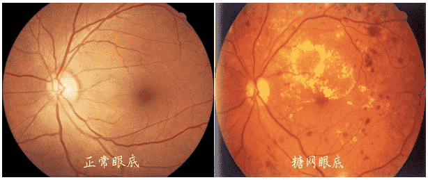 合肥愛爾眼科醫(yī)院：糖尿病患者，注意定期檢查眼底