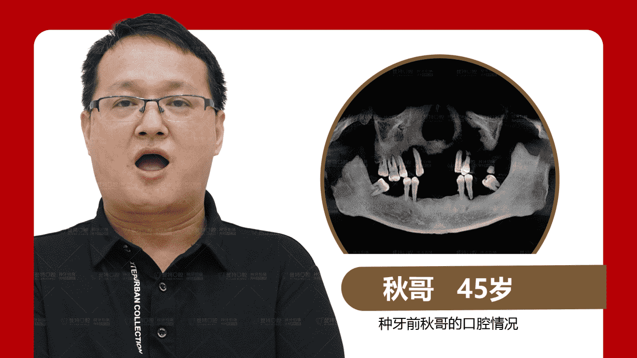 佛山登特口腔：全口半口缺牙修復(fù)方式怎么選？