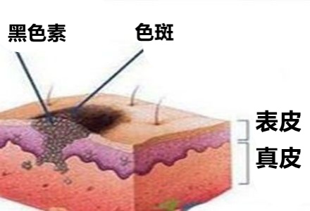 祛斑霜用出終生難愈皮炎，千金散去再也換不回一張健康臉！