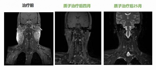 腫瘤放療“皇冠上的明珠”質(zhì)子治療，竟比普通放療更“省錢”