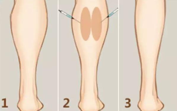 肌肉腿打瘦腿針有用嗎 塑形用時短便捷不反彈