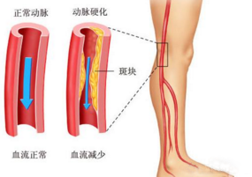 濟南中醫(yī)靜脈曲張醫(yī)院到底怎么去 謹防收費陷阱